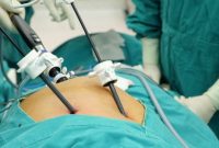 Ovarian Cystectomy - Verman Hospital Ovarian Cystectomy - Verman Hospital